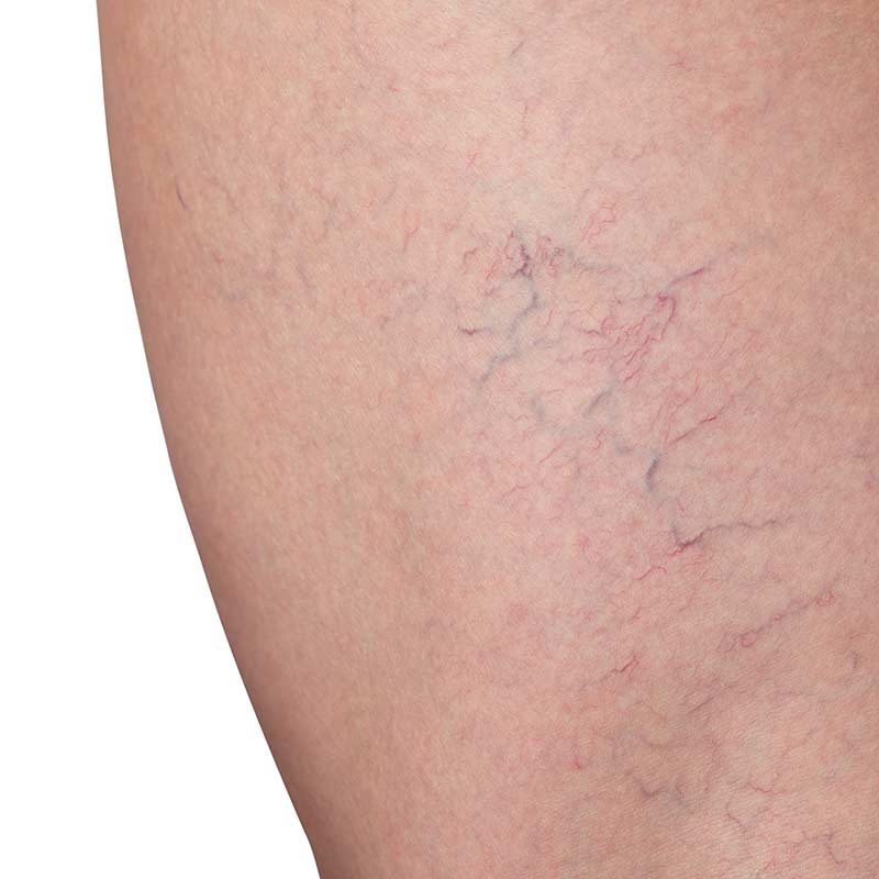 Im MVZ Hansaklinik in Dortmund werden Besenreiser nachhaltig behandelt.