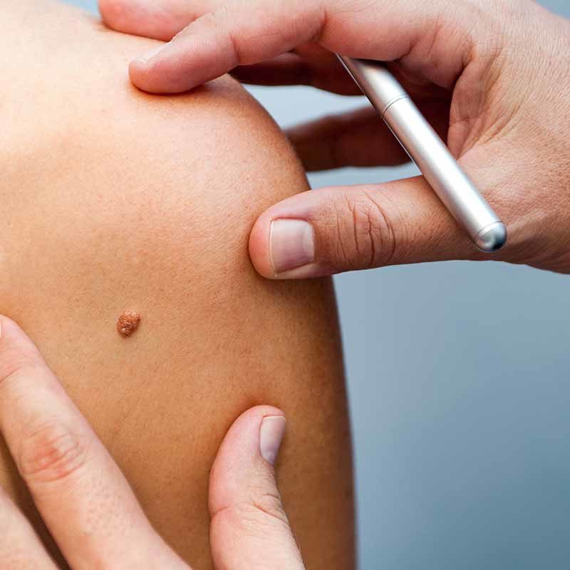 Dermatologische Hauterkrankungen behandeln im MVZ Hansaklinik in Dortmund