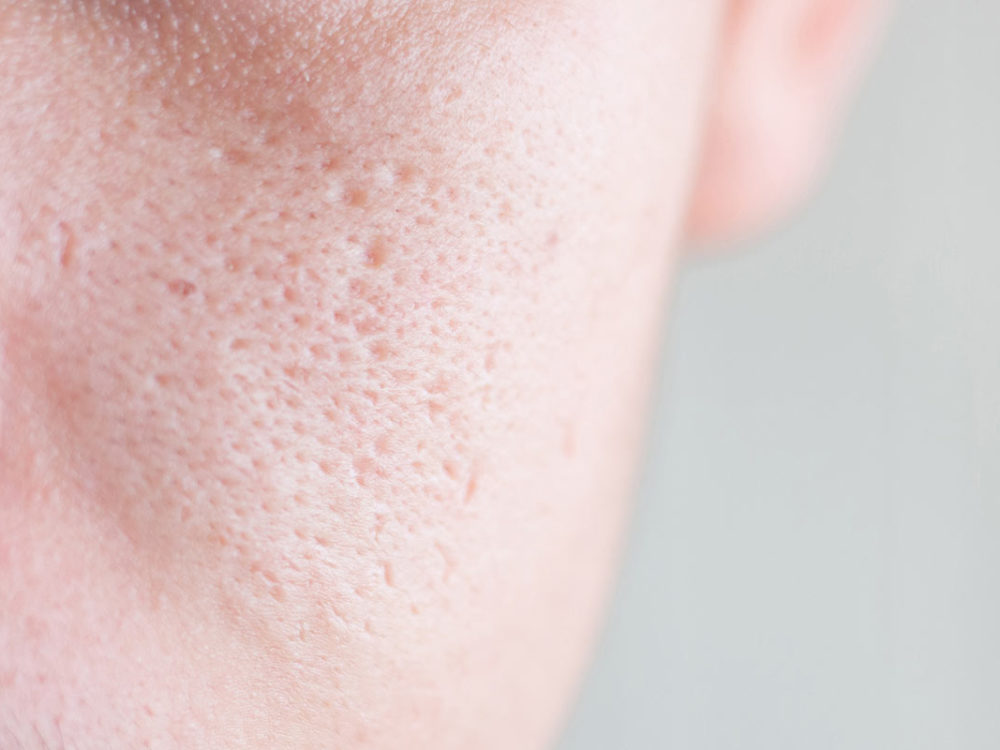 Die Behandlung von großporiger und unreiner Haut kann durch Laser erfolgen.