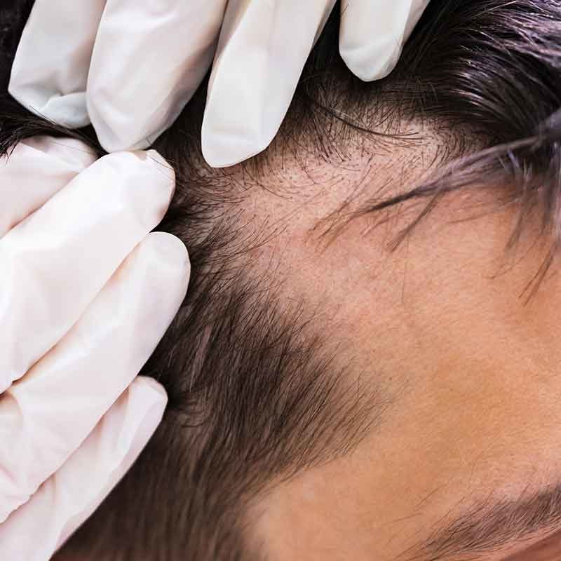 Haarausfall bei Männern behandeln im MVZ Hansaklinik in Dortmund