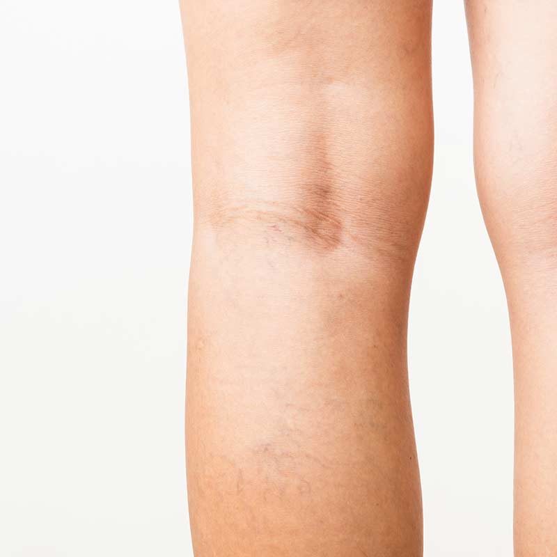 Die Ärzte vom MVZ Hansaklinik in Dortmund behandeln Krampfadern.