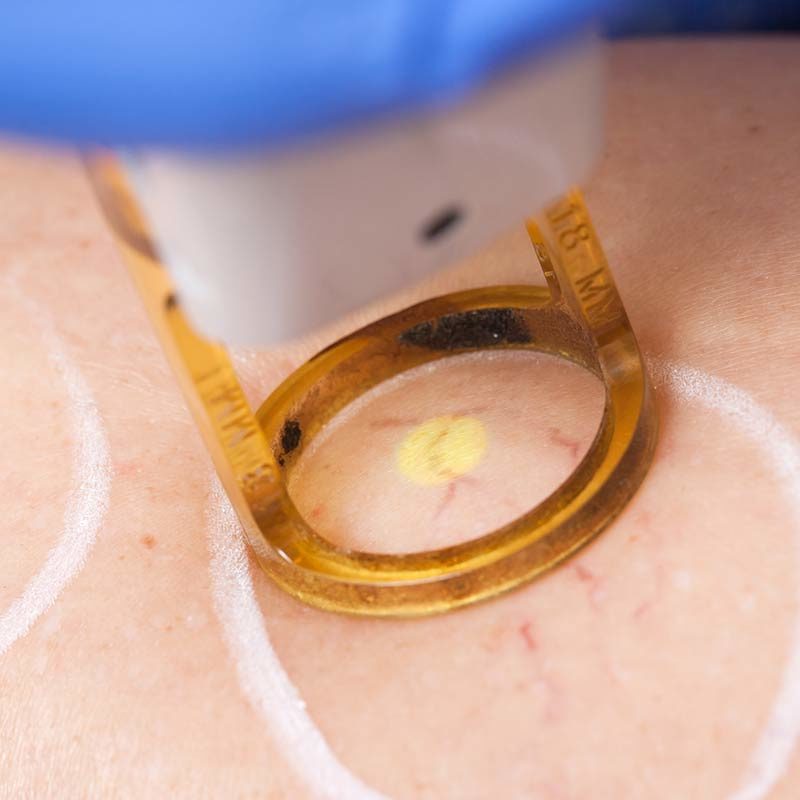 Lasertherapie im MVZ Hansaklinik