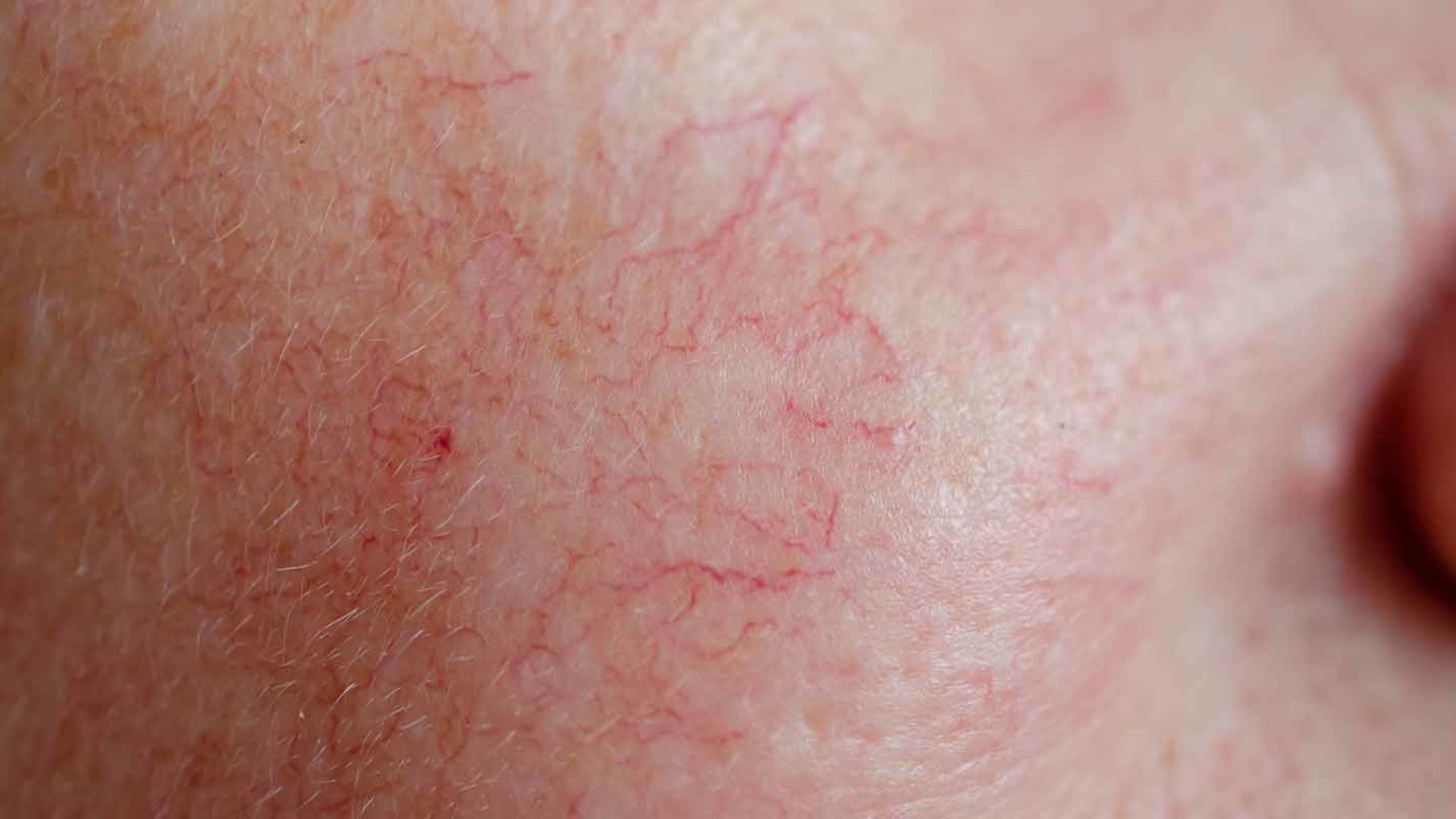 Rosacea im Gesicht kann durch verschiedene Behandlungsmethoden im MVZ Hansaklinik in Dortmund behandelt werden.