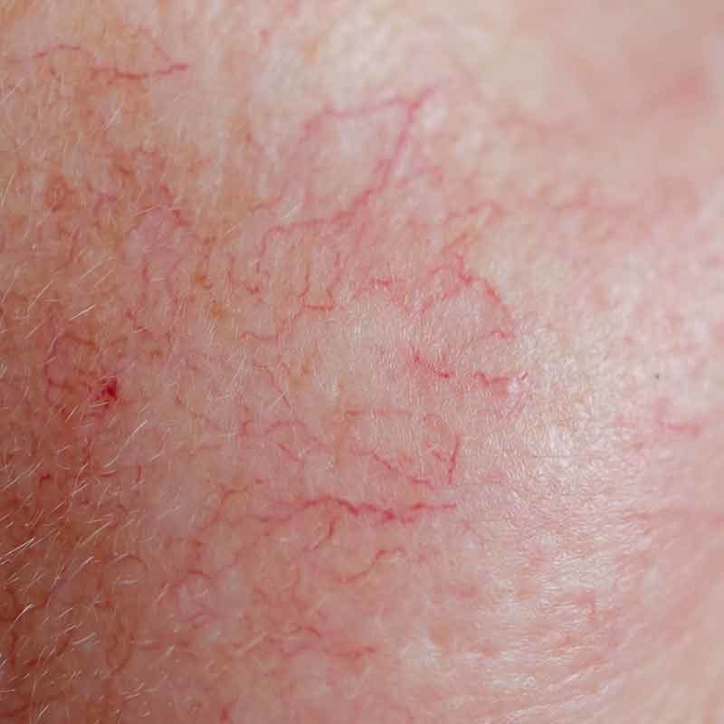 Rosacea im Gesicht kann durch verschiedene Behandlungsmethoden im MVZ Hansaklinik in Dortmund behandelt werden.