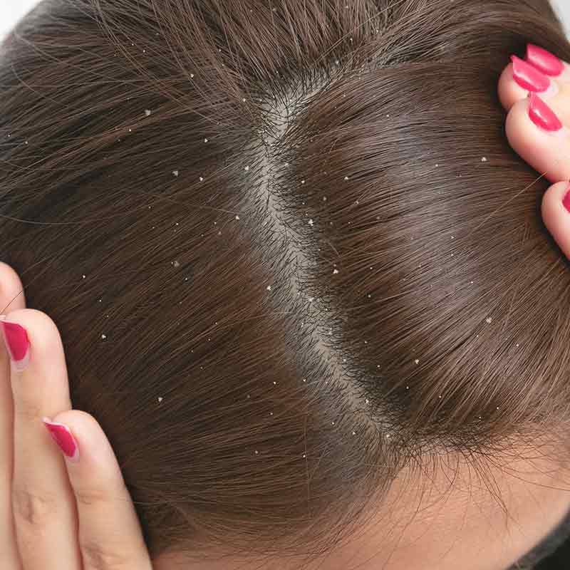 Schuppen auf der Kopfhaut und auf den Haaren werden im MVZ Hansaklinik in Dortmund behandelt.