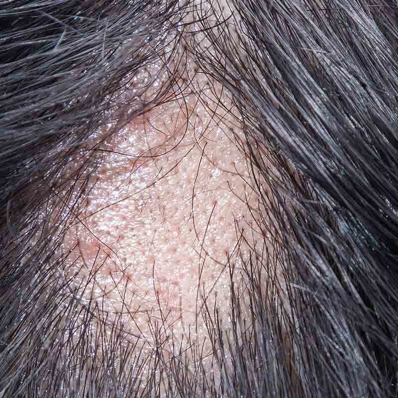 Vernarbender Haarausfall kann im MVZ Hansaklinik in Dortmund schonend behandelt werden.